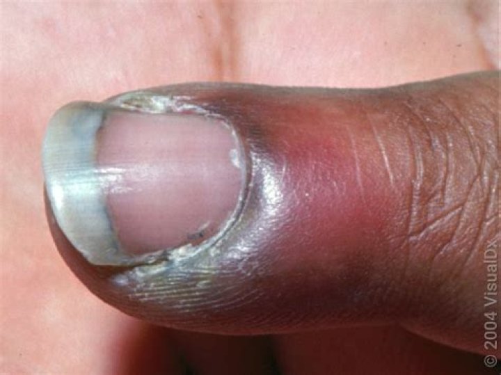 What does a infected finger look like?