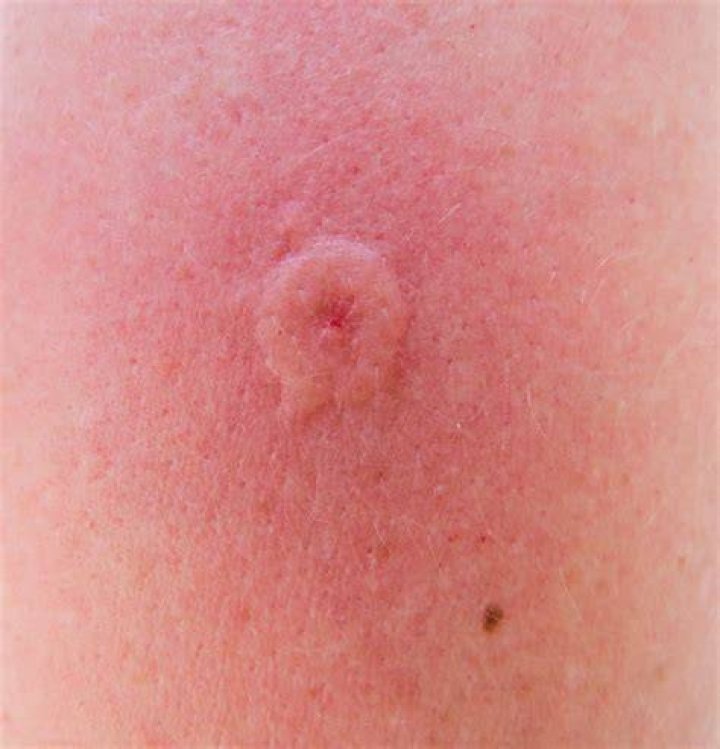 What does a wasp bite look like?