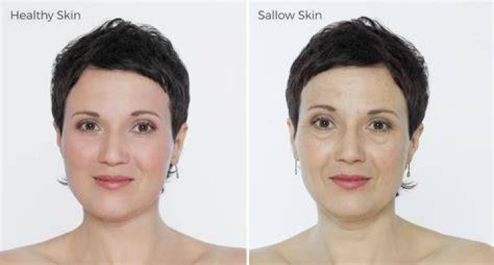 What does sallow skin look like?