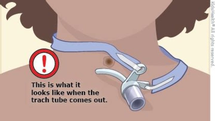 What happens after a breathing tube is removed?