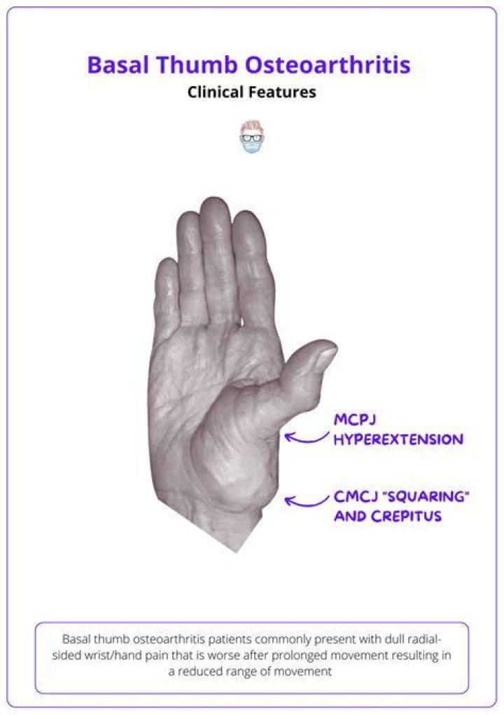 What is basilar thumb arthritis?