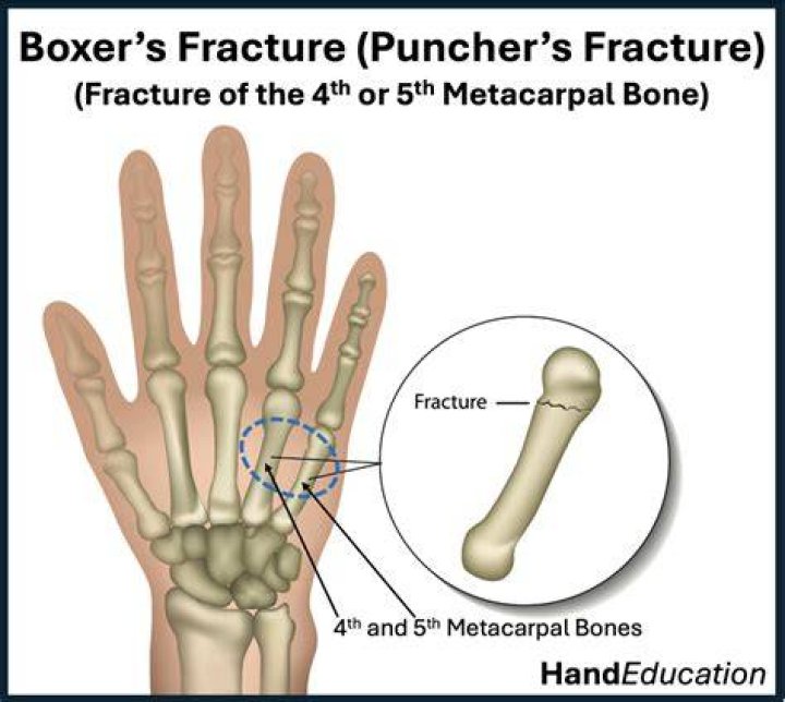 What is Boxer's knuckle?