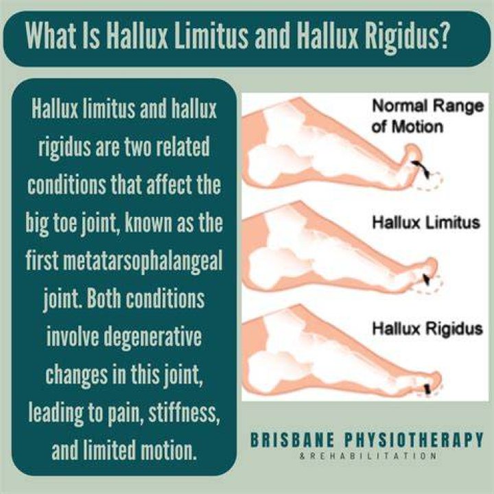 What is the difference between hallux rigidus and hallux valgus?