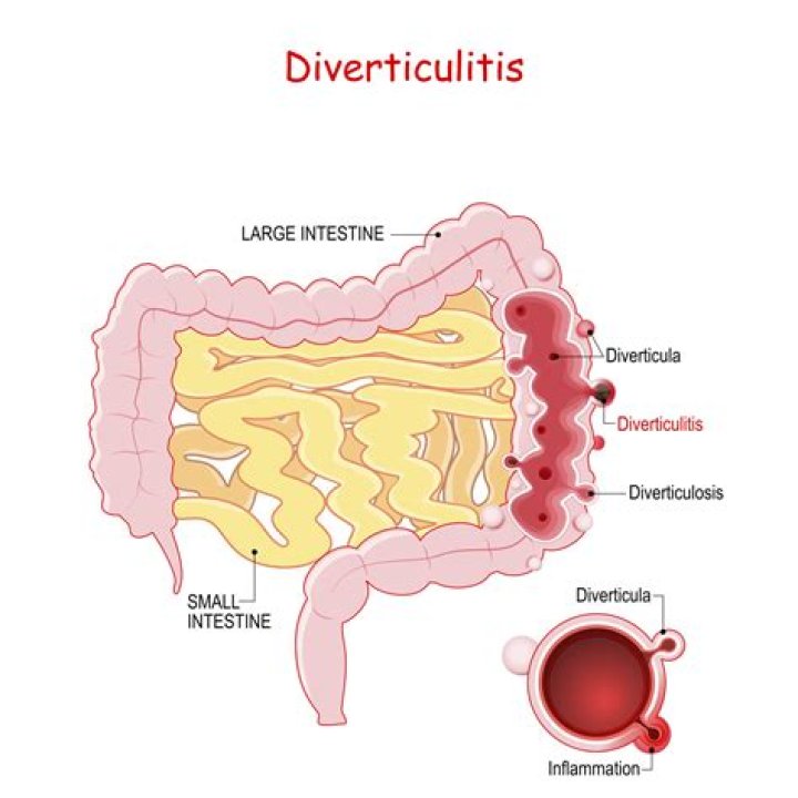 What kind of pain is diverticulitis?