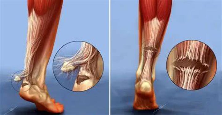 What ruptured tendon feels like?