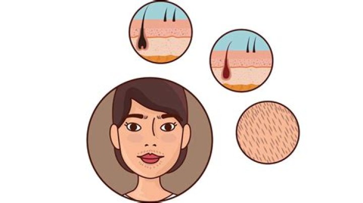 Which hormone causes facial hair growth in females?