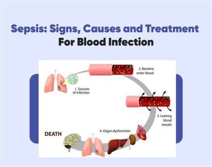 Why do I keep getting sepsis?
