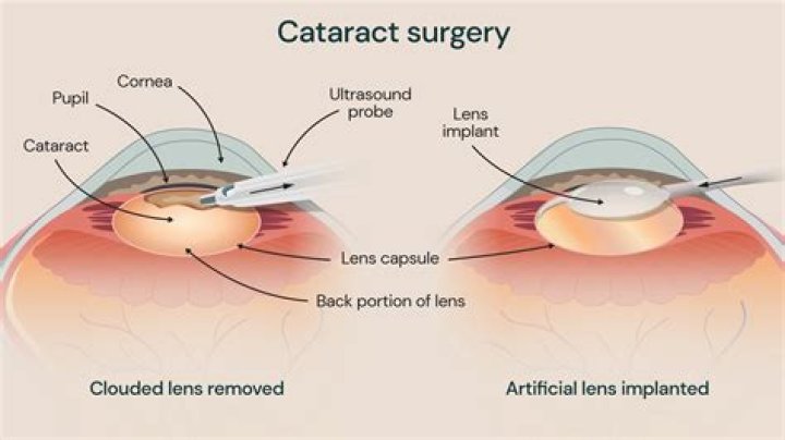 Why do I see Starburst after cataract surgery?