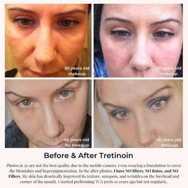 Why do my wrinkles look worse after retinol?