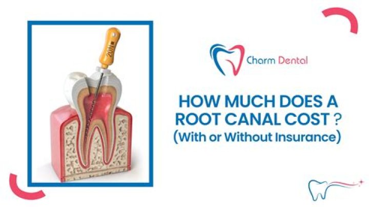 Why do root canals cost so much?