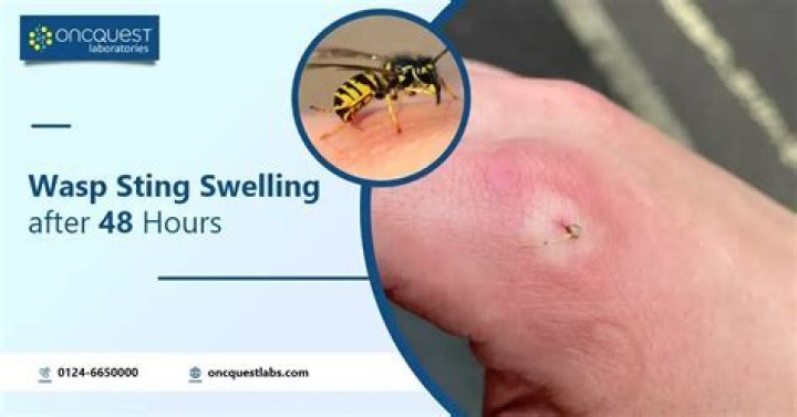 Why does wasp sting hurt so much?