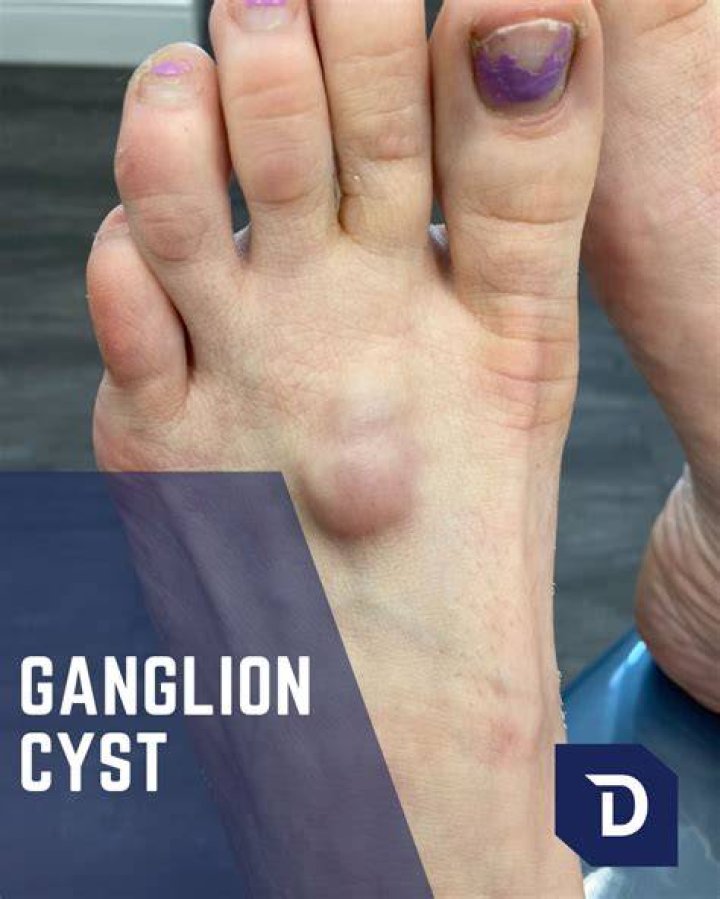 Will a ganglion cyst show up on MRI?