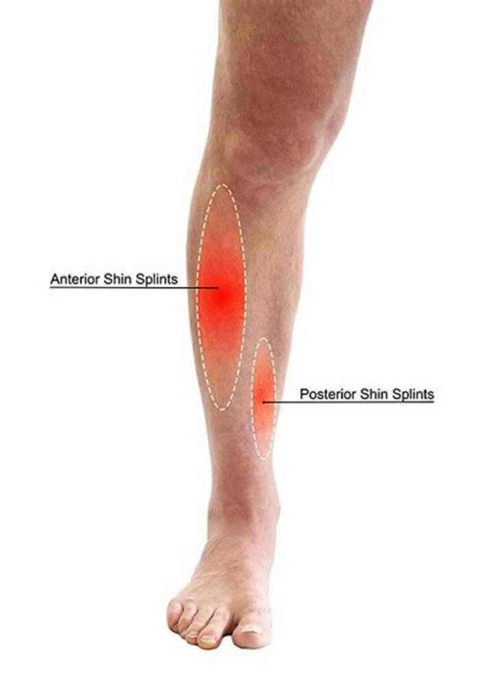Will shin splints go away if I keep running?