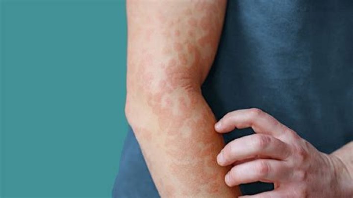 Will Zyrtec help with hives?